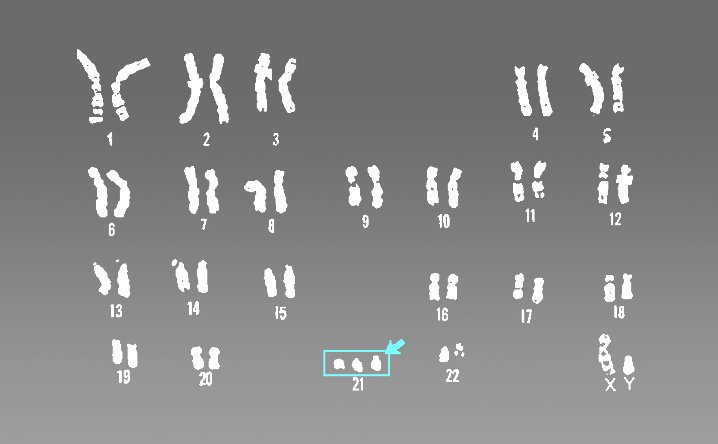 21_trisomy